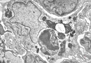 F, 36y. | generalized eruptive histiocytoma - histiocyte